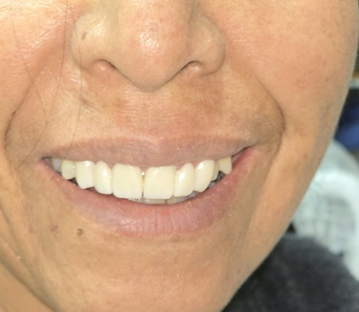 Resultado final de sonrisa radiante y garantía